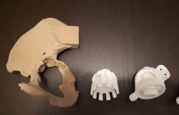Protesi all’anca in 3d impiantata a Ferrara