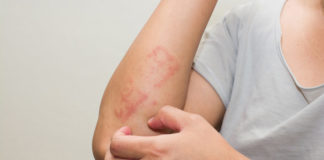 Psoriasi, un nuovo farmaco ottiene la rimborsabilita’ dall’Aifa