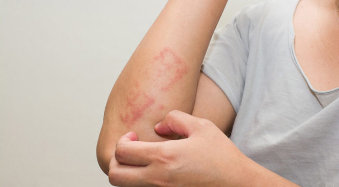 Psoriasi, un nuovo farmaco ottiene la rimborsabilita’ dall’Aifa