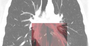 Ai-Score, l’intelligenza artificiale per calcolare il rischio Covid-19