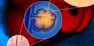 Salute, un anticorpo monoclonale per contrastare sindrome di Clouston