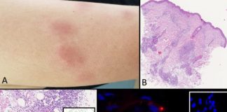 Nuovo paziente zero in Italia, è una donna contagiata a novembre 2019