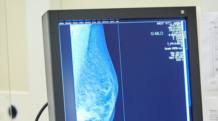 Tumore al seno, Europa Donna “Test genomici non ancora rimborsati”