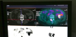 Tumore prostata, in uso nuovo radiofarmaco al “Cannizzaro” di Catania