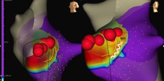 Una nuova tecnica di ablazione per le tachicardie pediatriche