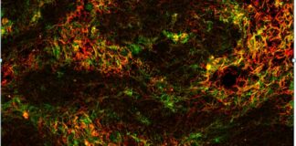 Sclerosi multipla, scoperto nuovo meccanismo di demielinizzazione