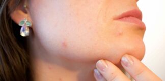 Arriva in Italia una nuova tecnologia laser contro l’acne