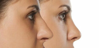 Chirurgia estetica: definizione, obiettivi ed esempi rinoplastica