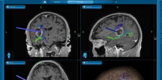 Caltanissetta, intervento neurochirurgico con l’aiuto della trattografia