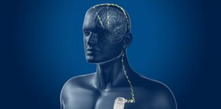 Parkinson, al Gemelli innovativa tecnica di neurostimolazione profonda
