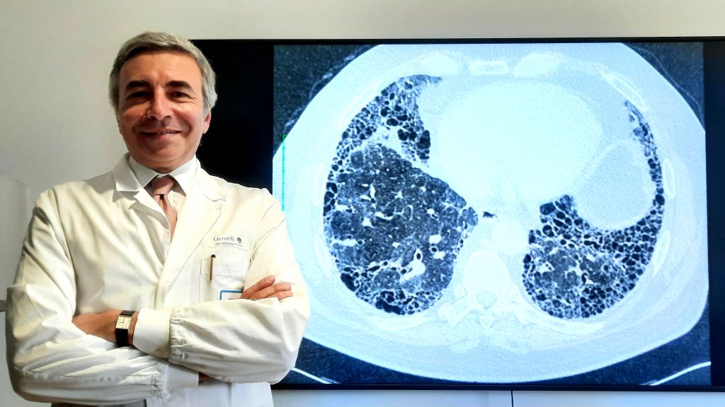 Fibrosi Polmonare Idiopatica, sul Nejm risultati studio Unicatt-Gemelli