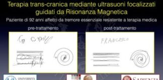 UniPa, risultati eccellenti da ultrasuoni focalizzati su paziente neurologico over90