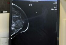 Tumore al seno, Fda approva un nuovo farmaco di Menarini