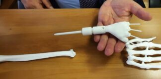 Un polso realizzato con una stampante 3D salva la mano di una neo-mamma