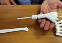 Un polso realizzato con una stampante 3D salva la mano di una neo-mamma