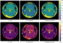 Con intelligenza artificiale lettura risonanza magnetica in 10 secondi