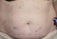 Eccessi cutanei post-dimagrimento, un aiuto dalla chirurgia plastica