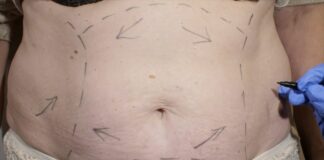 Eccessi cutanei post-dimagrimento, un aiuto dalla chirurgia plastica