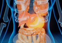 Calcoli alla colecisti, ittero e pancreatite i pericoli maggiori