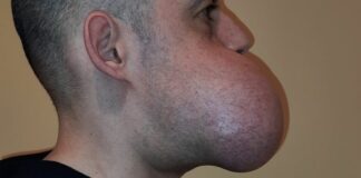 All’IRCCS Galeazzi-Sant’Ambrogio asportato ameloblastoma di 1,4 kg