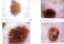 Melanomi e altri tumori della pelle, i consigli dell’esperto