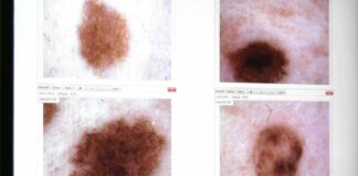 Melanomi e altri tumori della pelle, i consigli dell’esperto