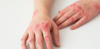 Salutequità e Apiafco “La psoriasi entri nel Piano Nazionale Cronicità”