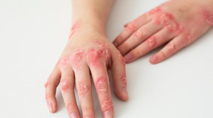 Salutequità e Apiafco “La psoriasi entri nel Piano Nazionale Cronicità”