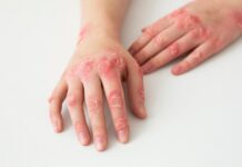 Salutequità e Apiafco “La psoriasi entri nel Piano Nazionale Cronicità”