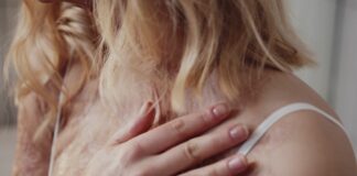 Rimedi alle ustioni, cruciale l’escarectomia selettiva precoce