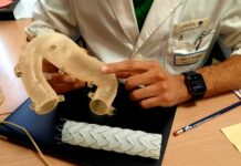 Al Gemelli chirurgia vascolare di precisione con protesi aortica su misura