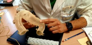 Al Gemelli chirurgia vascolare di precisione con protesi aortica su misura