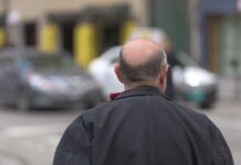 Trapianto di capelli: crescono gli italiani che scelgono la Turchia uomo con calvizie