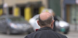 Trapianto di capelli: crescono gli italiani che scelgono la Turchia uomo con calvizie