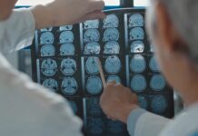 Tumori al cervello, grandi passi avanti nella neurochirurgia