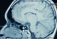 Ultrasuoni focalizzati, alta tecnologia al servizio della neurochirurgia