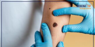 Passi avanti nella cura del melanoma, presto il vaccino