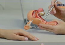 Comuni e quasi sempre benigni, come trattare i fibromi uterini