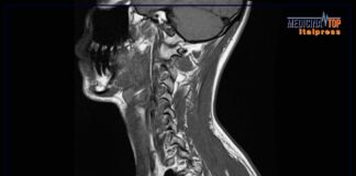 Tumori dell’orofaringe in aumento, segnali e importanza dei vaccini