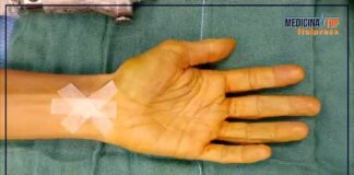 Sindrome del tunnel carpale, anche artrite e obesità tra le cause