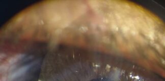 A Torino nuovi occhi per fratello e sorella nati senza iride