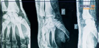 Artrite e artrosi, sintomi comuni ma cause e cure diverse