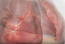 Innovazioni terapeutiche nella BPCO con enfisema