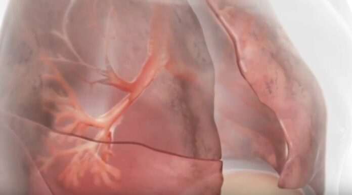 Innovazioni terapeutiche nella BPCO con enfisema