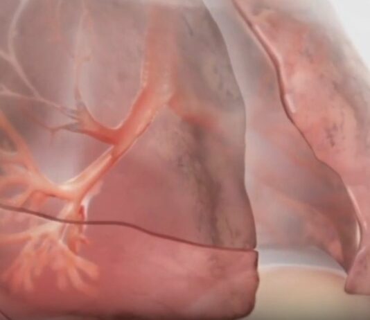 Innovazioni terapeutiche nella BPCO con enfisema