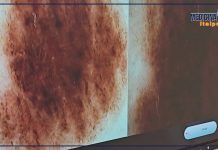 Tumori cutanei non melanoma in costante aumento in Italia, ecco perché