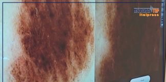 Tumori cutanei non melanoma in costante aumento in Italia, ecco perché