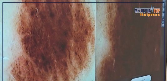 Tumori cutanei non melanoma in costante aumento in Italia, ecco perché