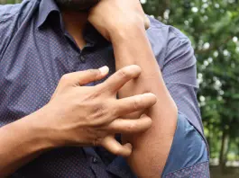 Studio Novartis, l’orticaria cronica spontanea costa 4.200 euro l’anno a paziente