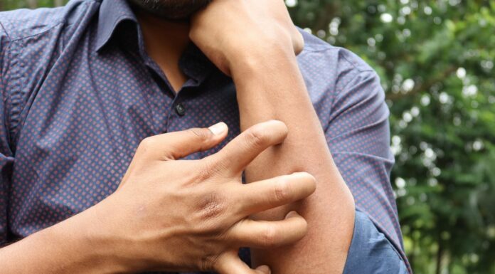 Studio Novartis, l’orticaria cronica spontanea costa 4.200 euro l’anno a paziente